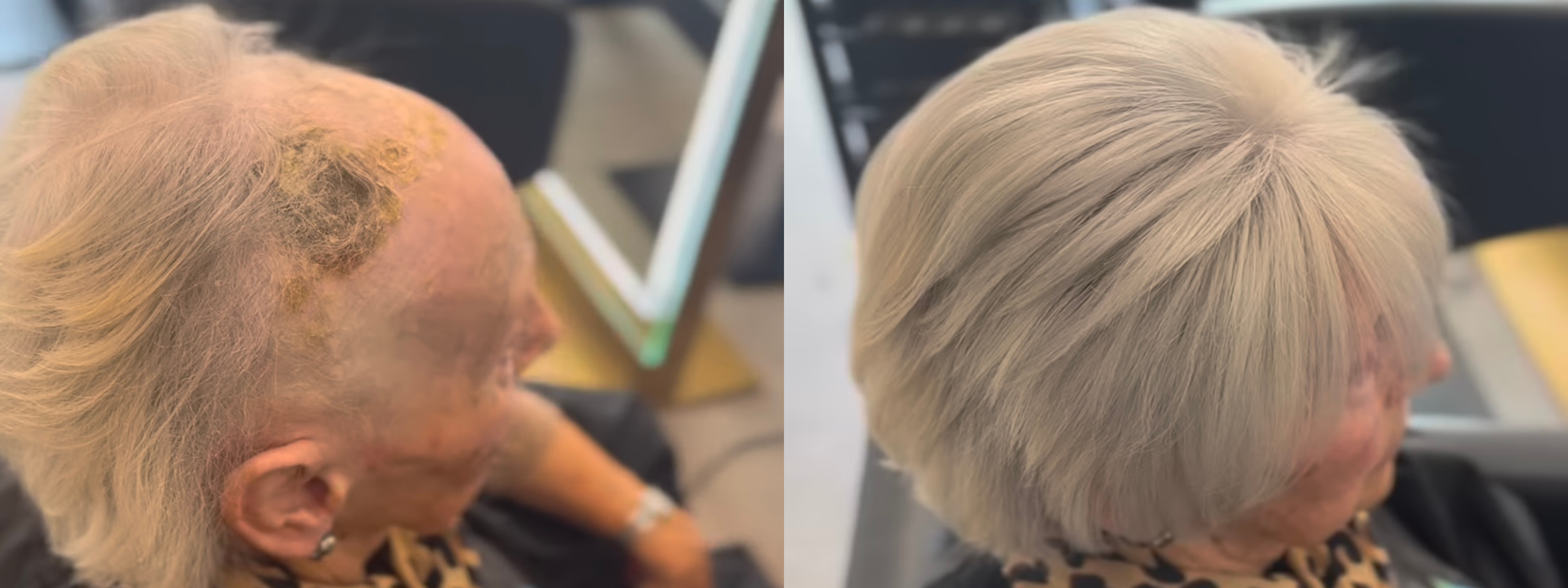 Hairloss Before And Afters