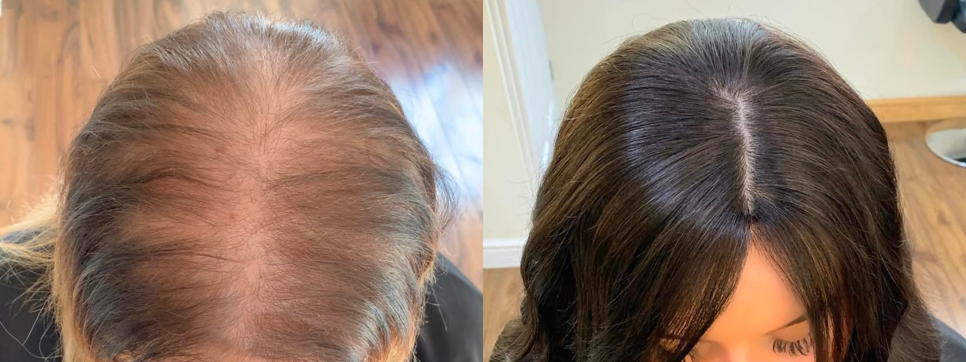 Hairloss Before And Afters