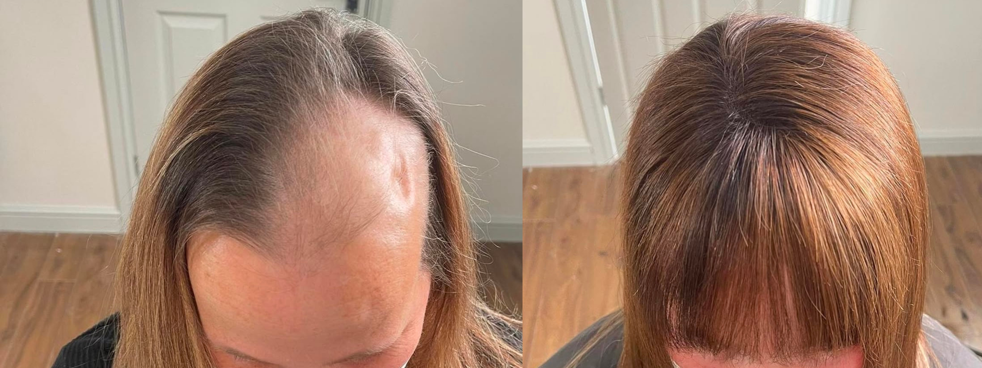 Hairloss Before And Afters