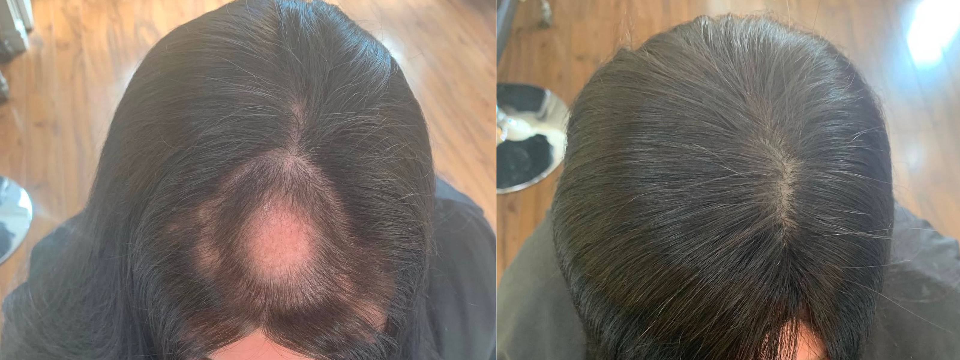 Hairloss Before And Afters